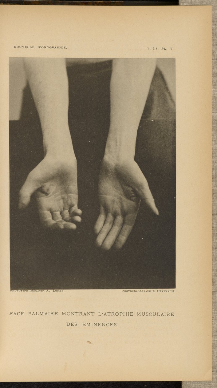 Palmar oppervlak met spieratrofie van de eminences door Albert Londe