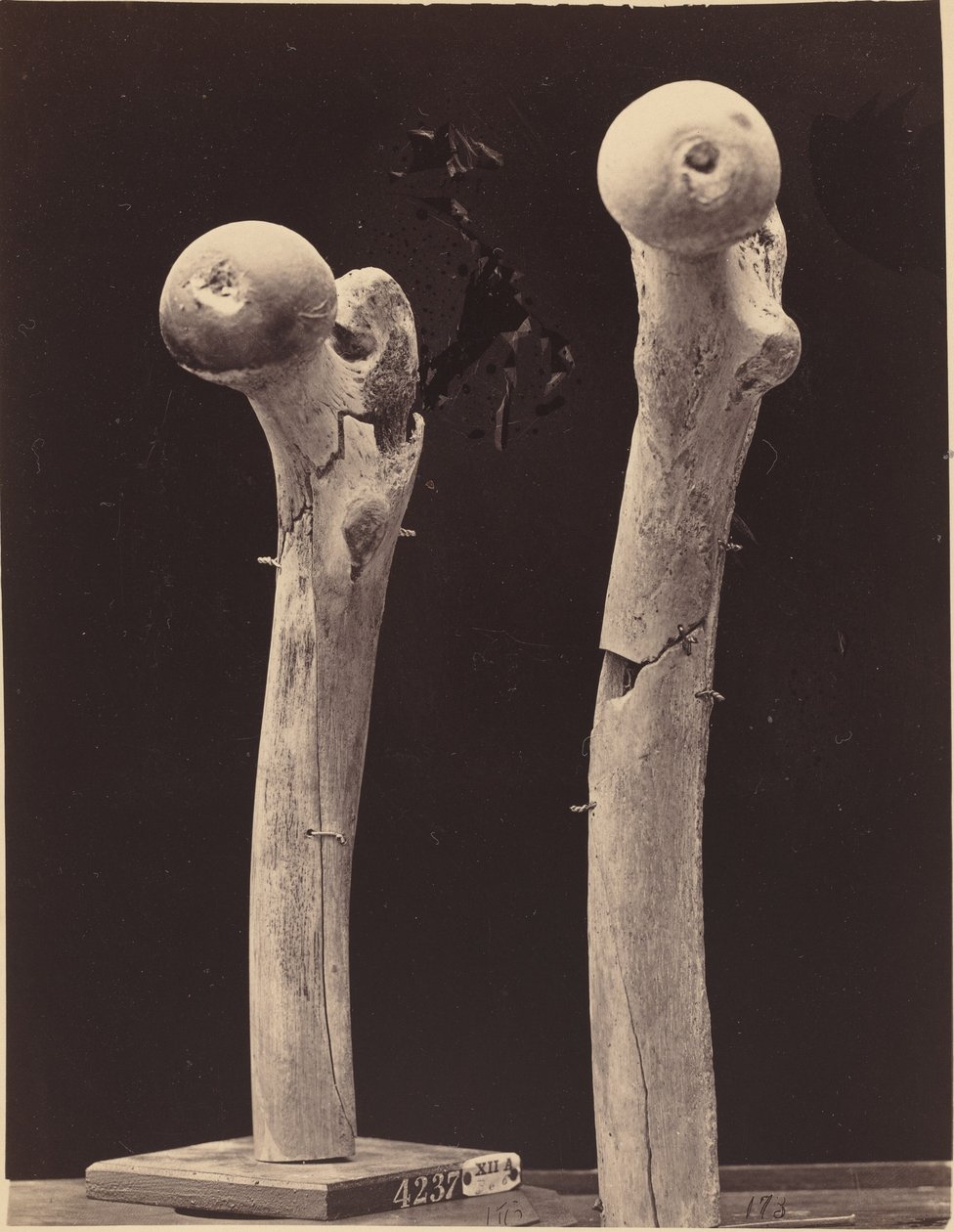 Specimens van Schotwonden aan het Dijbeen door American 19th Century