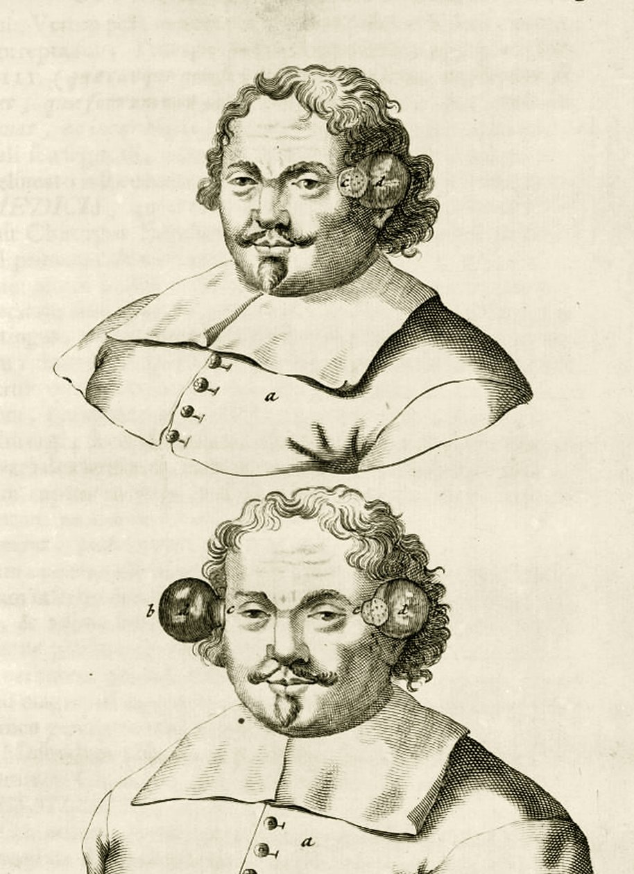 Een voorbeeld van koppen, uit Exercitationes Practicae circa Medendi Methodum door Frederik Dekkers, 1694 door Dutch School