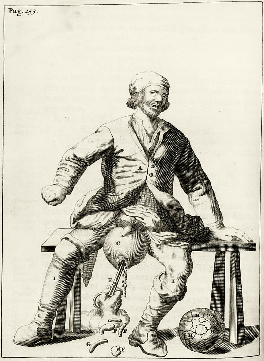 Aftappen van vocht uit een hydrocele van het scrotum, uit Exercitationes Practicae circa Medendi Methodum door Frederik Dekkers, 1694 door Dutch School