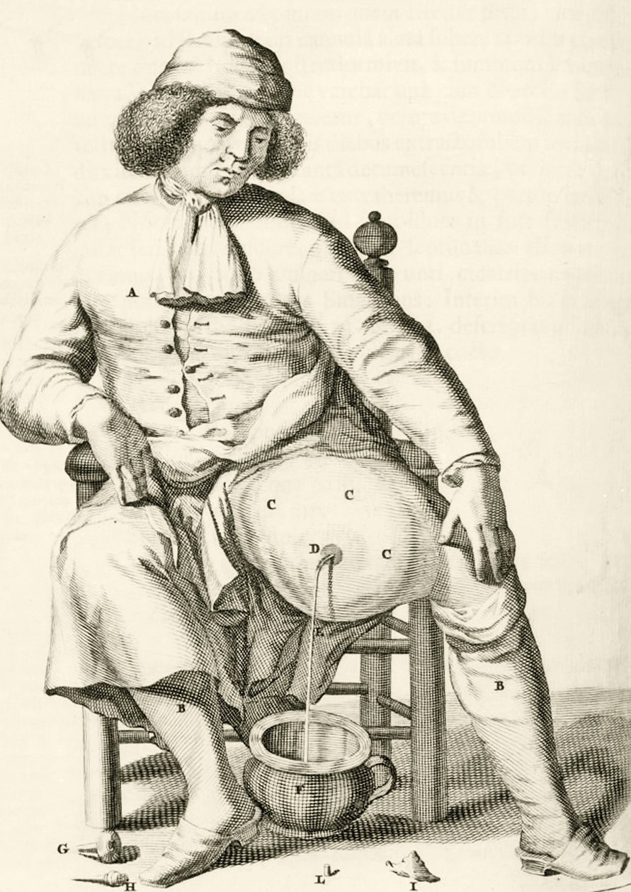 Aftappen van vocht uit een abces, uit Exercitationes Practicae circa Medendi Methodum door Frederik Dekkers, 1694 door Dutch School