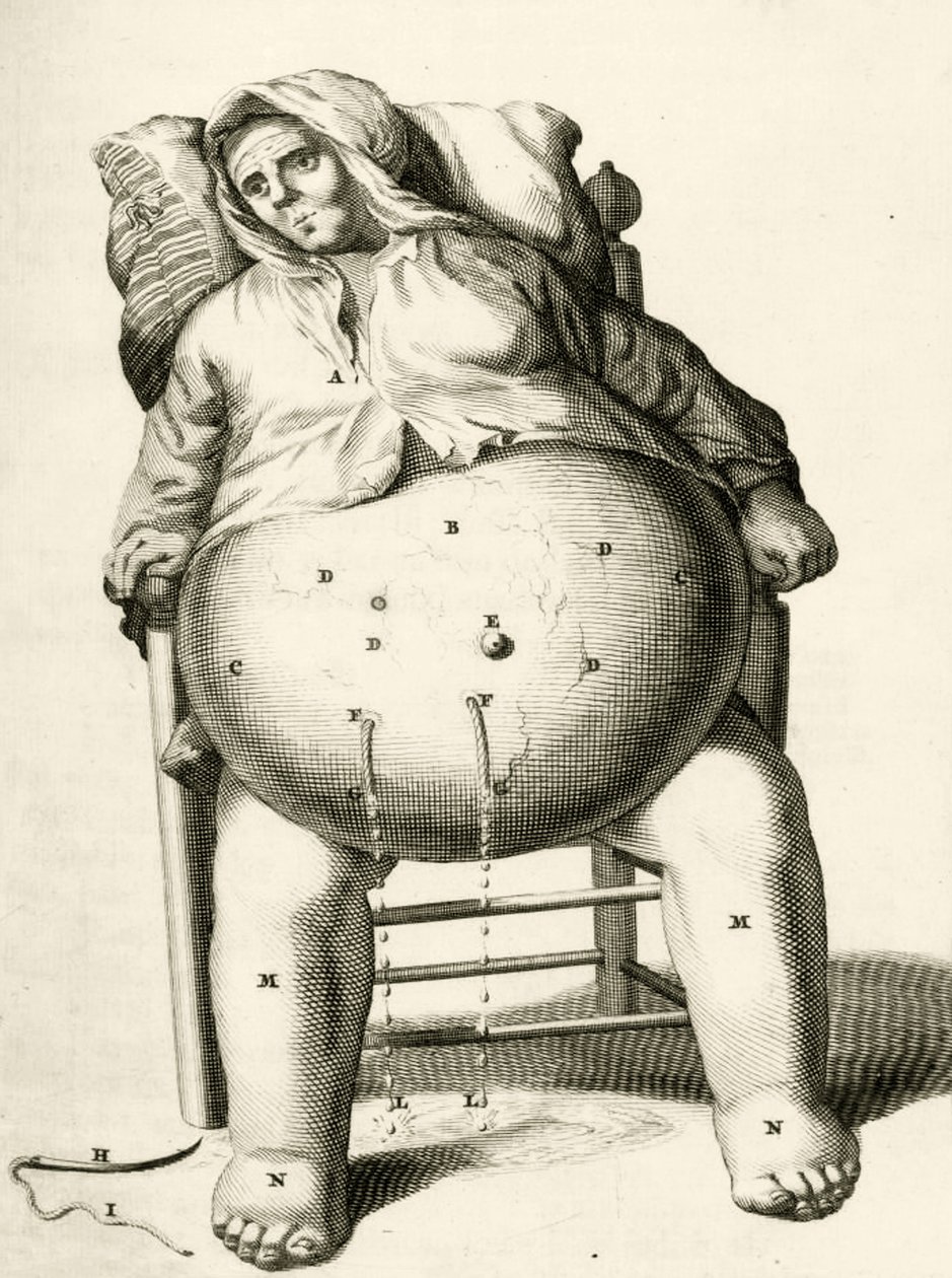 Aftappen van vocht uit een abces, uit Exercitationes Practicae circa Medendi Methodum door Frederik Dekkers, 1694 door Dutch School