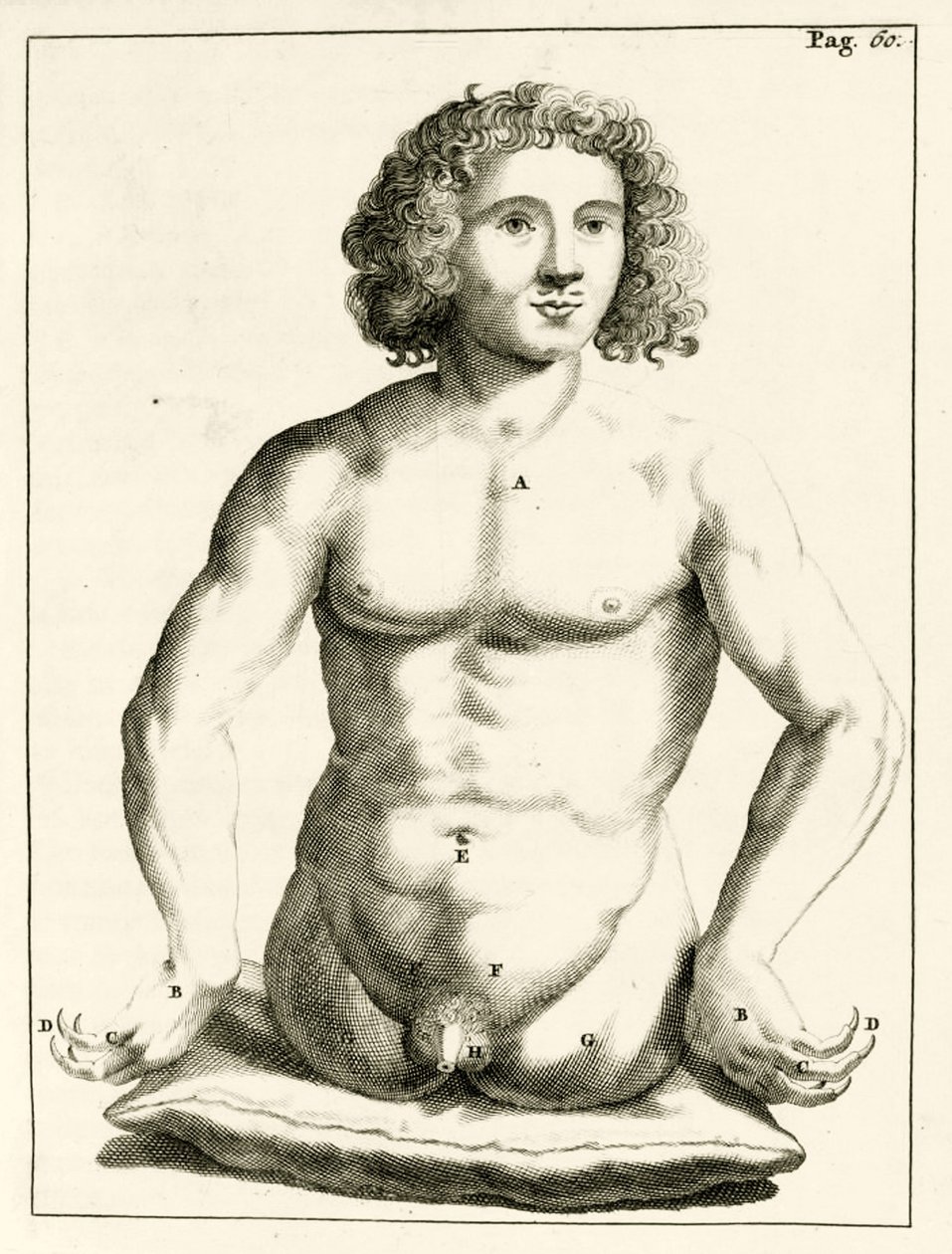 Voorbeeld van aangeboren geboorteafwijkingen, uit Exercitationes Practicae circa Medendi Methodum door Frederik Dekkers, 1694 door Dutch School