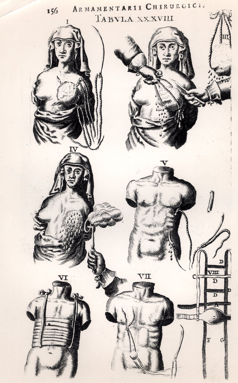 Operatie voor borstkanker, uit Armamentarii Chirurgici door Johannes Schultes (1595-1645) gepubliceerd in Amsterdam, 1672 door Dutch School