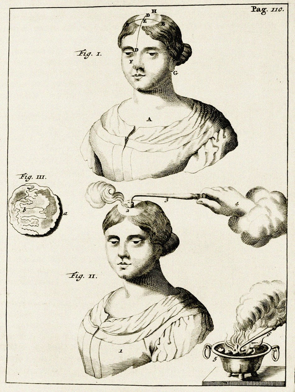 Behandeling van een epilepsiepatiënt, uit Exercitationes Practicae circa Medendi Methodum door Frederik Dekkers, 1694 door Dutch School