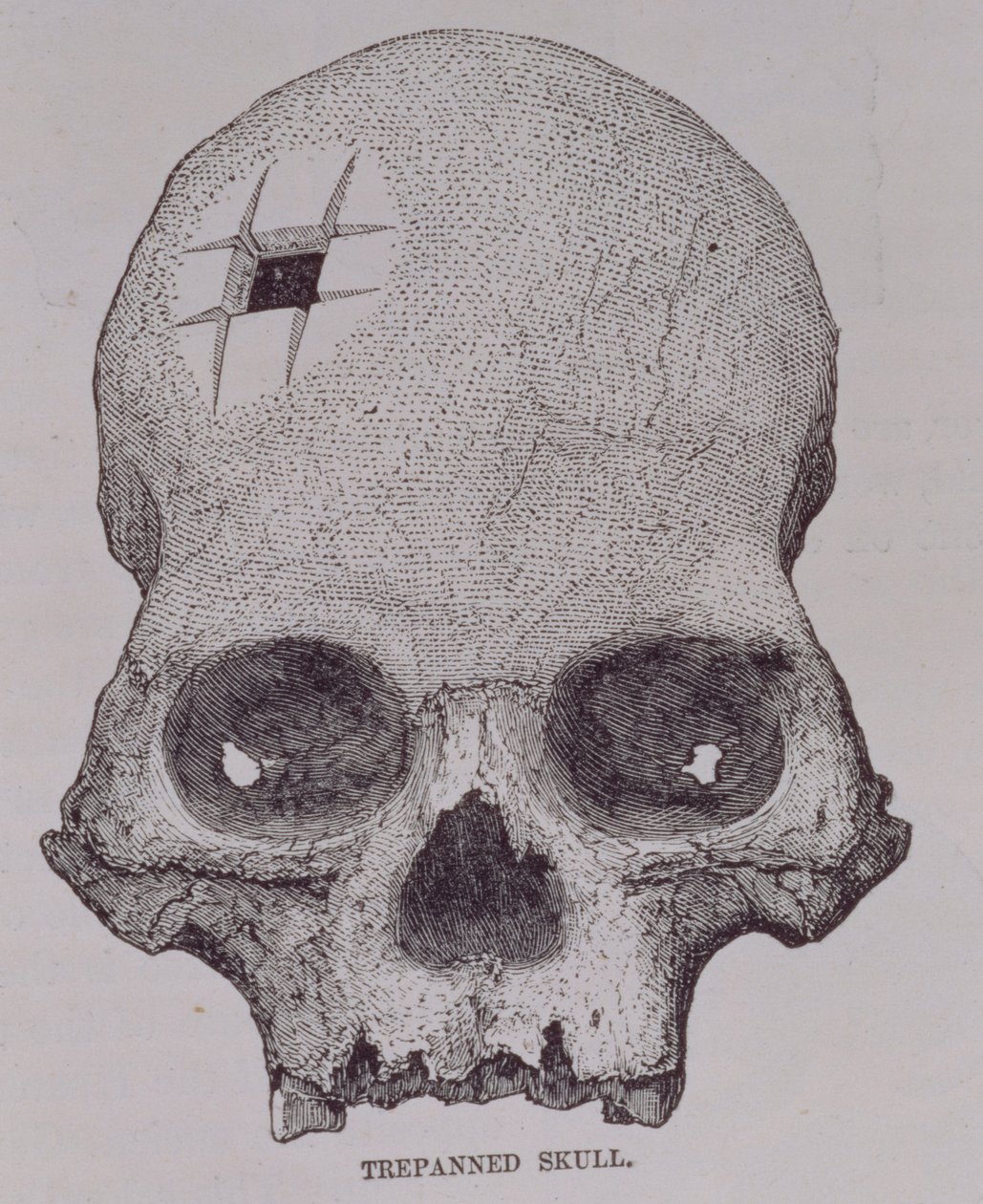 Een Getrepaneerde Schedel, uit 