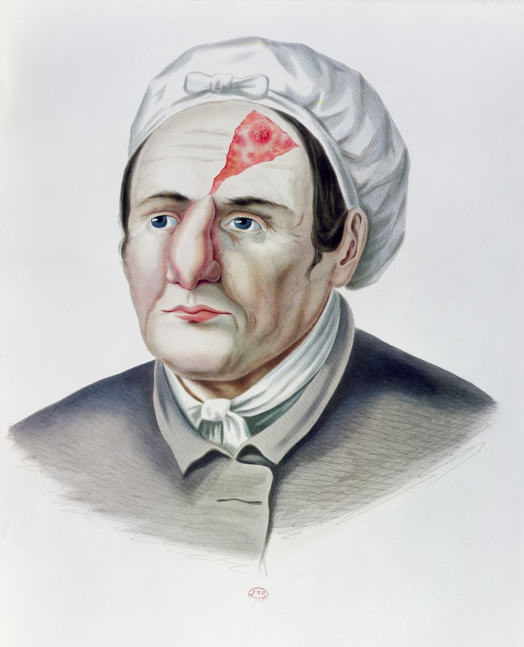 Na een huidtransplantatie-operatie, uit Selecta Praxis Medico-Chirurgica door Alexander Auvert, Parijs, 1856 door French School