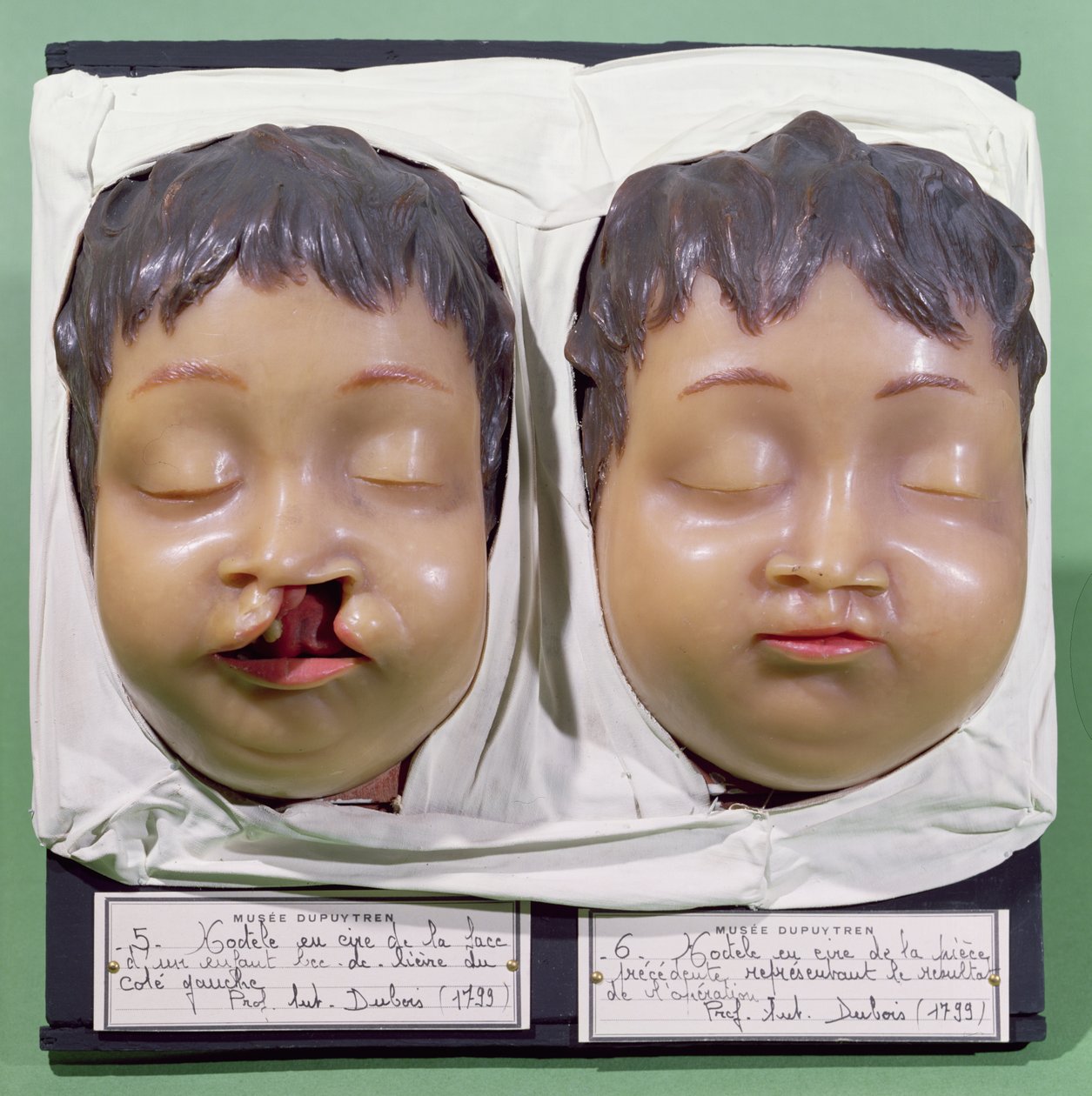 Model dat een kinderlijk gezicht toont voor en na een operatie om een hazenlip te corrigeren uitgevoerd door Antoine Dubois (1756-1837) in 1799 (was) door French School