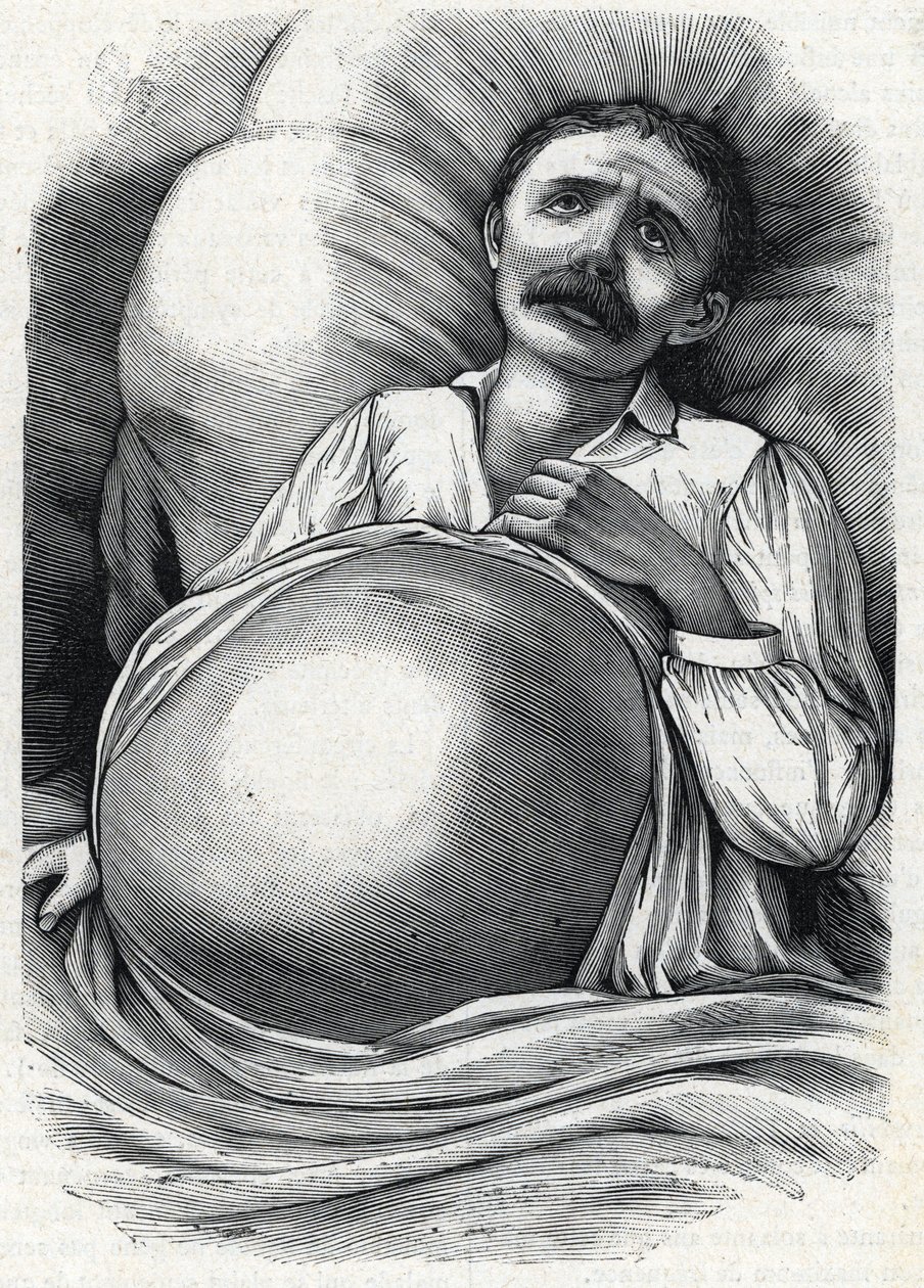 Patiënt met gevorderde levercirrose (gravure) 1888 door French School