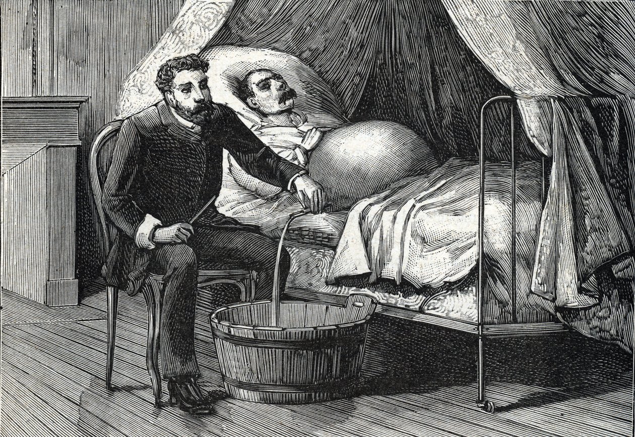 Patiënt met gevorderde levercirrose, dokter voert een punctie uit (gravure) 1888 door French School