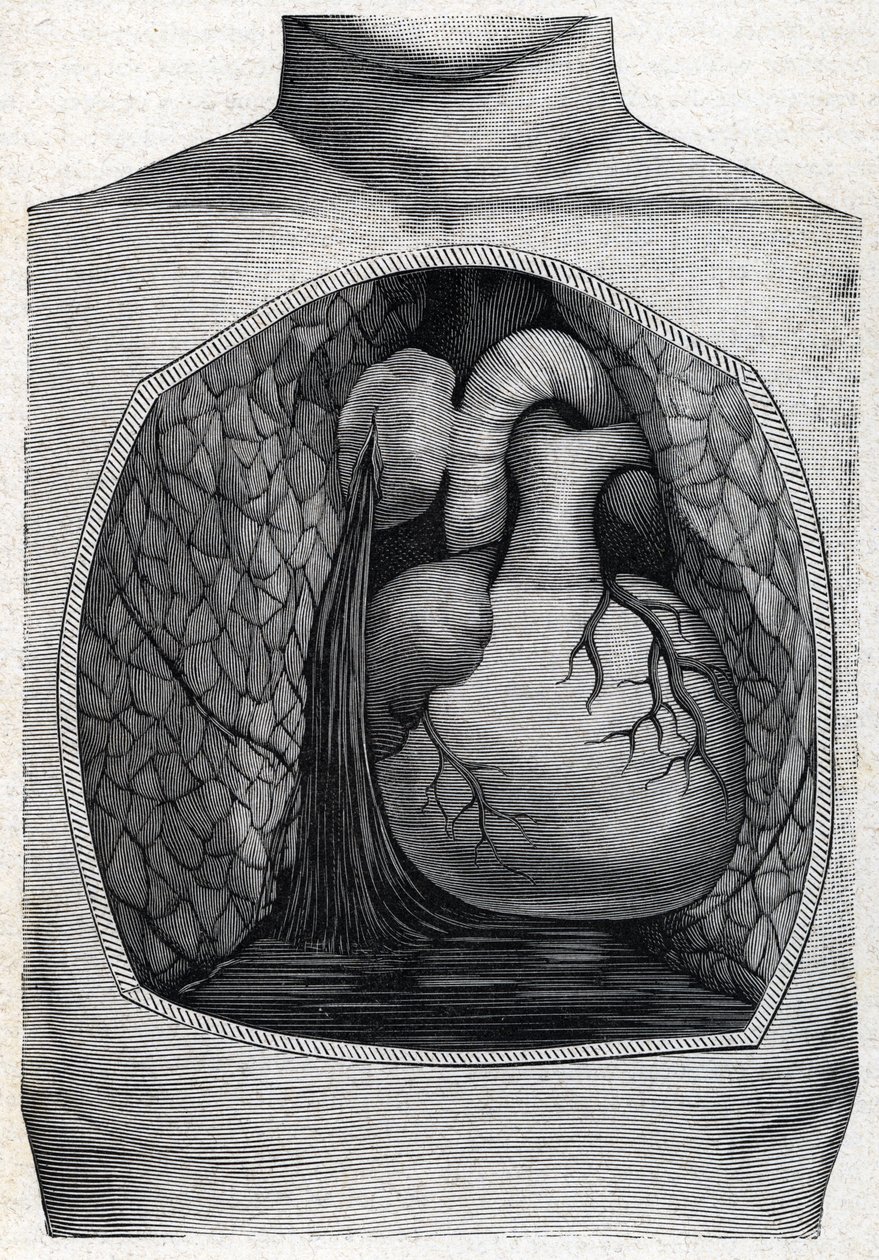 Aneurysma ruptuur, 1888 door French School