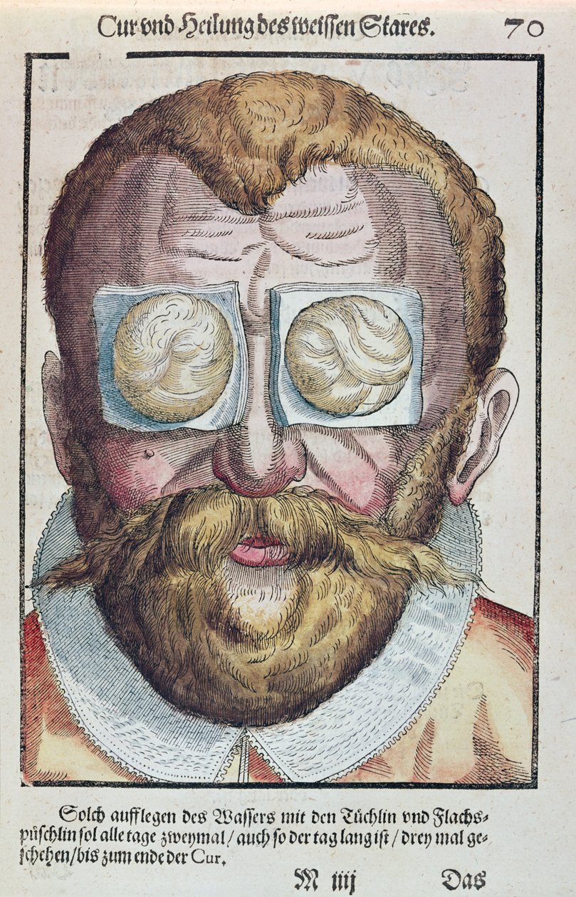Behandeling van een oogkwaal, uit Ophthalmodouleia door Georg Bartisch, gepubliceerd in Dresden in 1583 door German School