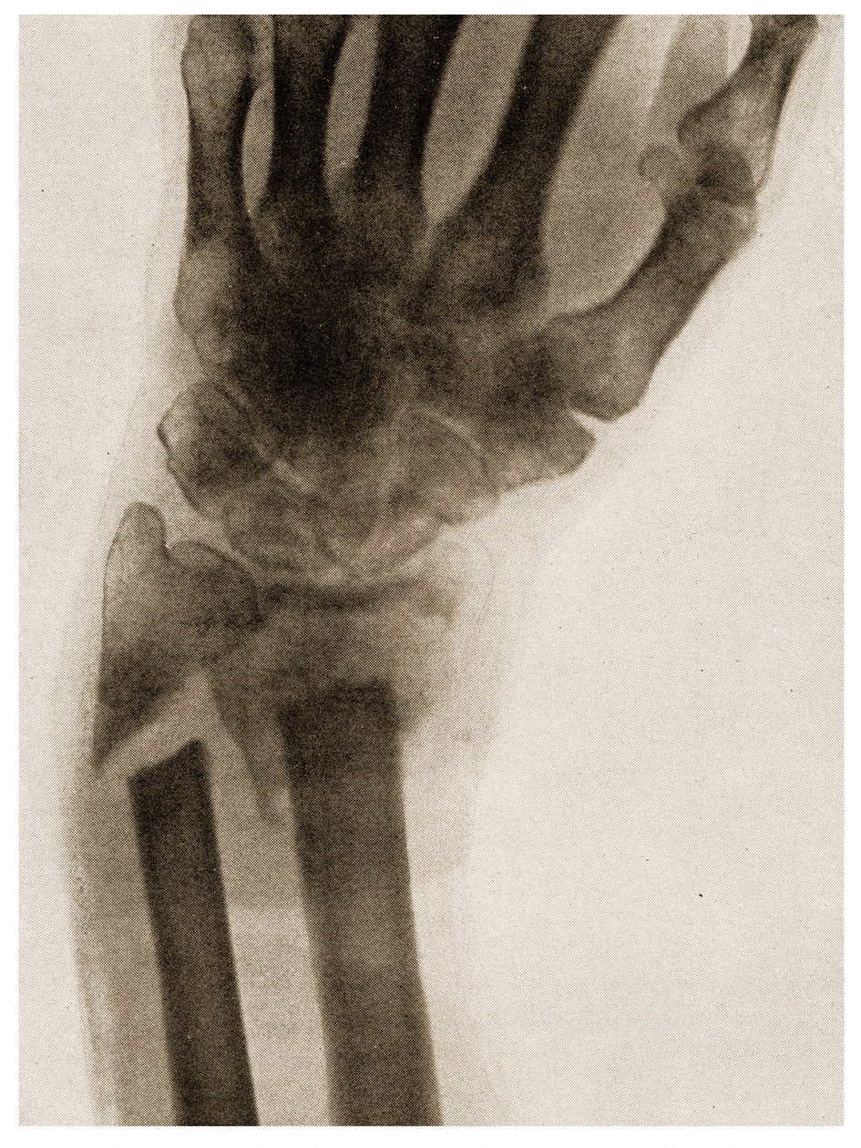 Röntgenfoto van een Gebroken Pols, ca. 1890 door German School