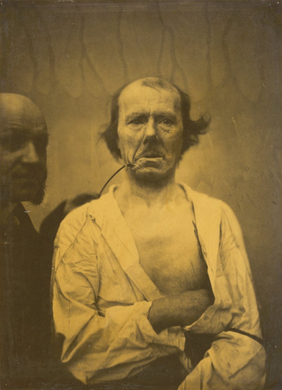 Een ontspannen uitdrukking (links); Walging (rechts),1854-1856, gedrukt 1862 (foto) door Guillaume Benjamin Armand Duchenne de Boulogne
