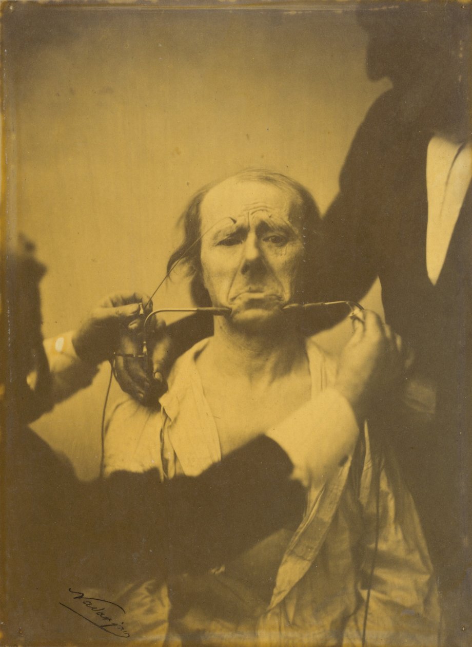 Pijn en wanhoop,1854-1856, gedrukt 1862 (foto) door Guillaume Benjamin Armand Duchenne de Boulogne