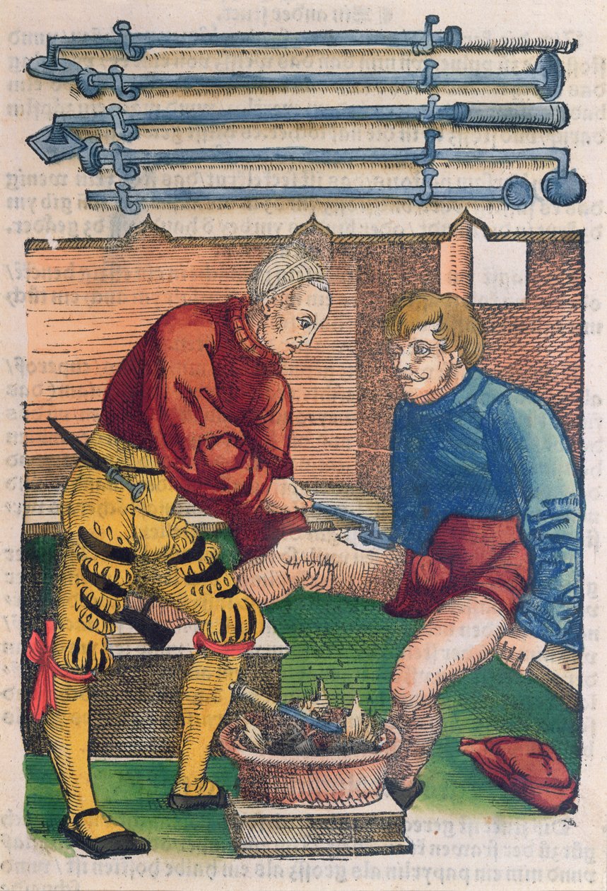 Cauterisatie, illustratie uit 