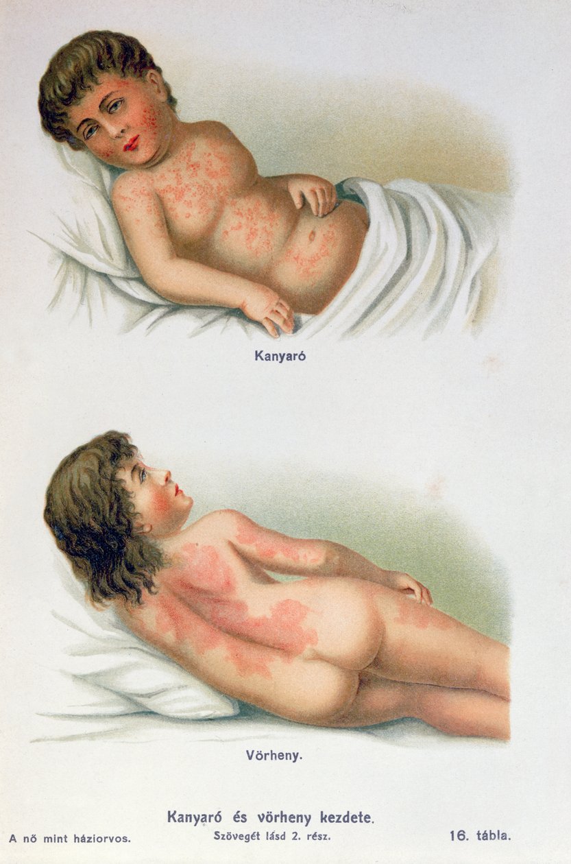 Mazelen en roodvonk, uit een familie medisch boek, c.1900 door Hungarian School