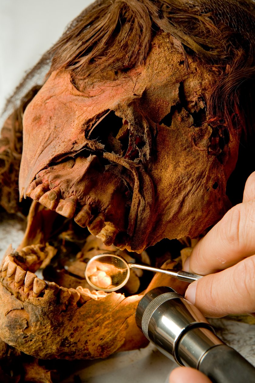 Dr. John Varano van Tulane University onderzoekt de tanden van de mummie. door Ira Block
