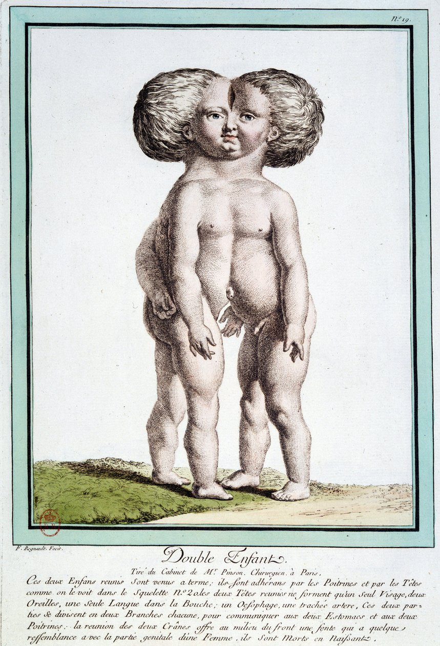 Siamese kinderen - in "Les déviations de la nature" door Régnault door Jean Baptiste Regnault