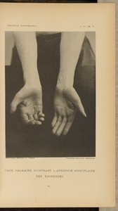 Palmar oppervlak met spieratrofie van de eminences door Albert Londe