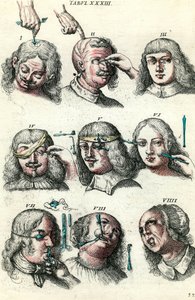 Chirurgie in de 18e eeuw: Trepanatie en operatie van het oog en gezicht. Gravure in 