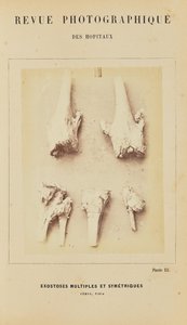 Meerdere symmetrische exostosen, femur, tibia door Arthur de Montmeja