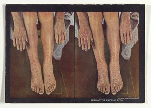 Dermatitis Exfoliativa door Dr. Selden I. Rainforth