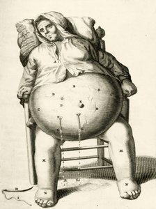 Aftappen van vocht uit een abces, uit Exercitationes Practicae circa Medendi Methodum door Frederik Dekkers, 1694