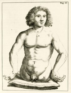 Voorbeeld van aangeboren geboorteafwijkingen, uit Exercitationes Practicae circa Medendi Methodum door Frederik Dekkers, 1694 door Dutch School