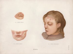 Huidaandoeningen: Herpes door English School
