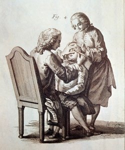 Een arts die een cataractpatiënt opereert, illustratie uit de Medische Encyclopedie van Denis Diderot en Jean le Rond d