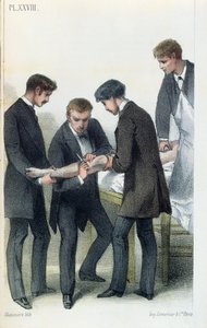 Amputatie van een arm, uit een medisch handboek door Jean-Baptiste-Leon Dubreuil, ca. 1850-60 door French School