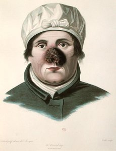 Voor een huidtransplantatie, uit 