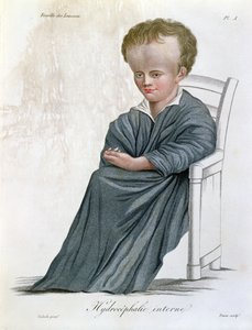 Interne hydrocefalie, uit Nosologie Naturelle door Baron Jean Louis Alibert (1768-1837) gegraveerd door Tresca, 1817