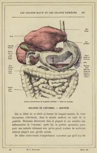 Kenmerkende laesies van ulceratieve gastritis, maagzweer