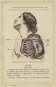 Luxatie onder het coracoïde van de schouder, verplaatsing van de kop van de humerus door French School