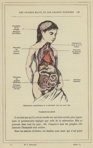 Kenmerkende manifestaties van tuberculose bij een jong meisje