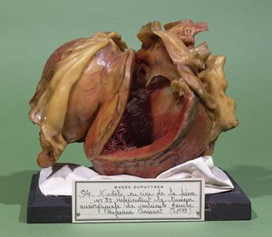 Model van een tumor van de linker hartkamer, 1799 (was)