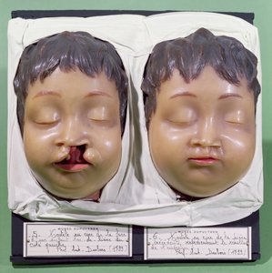 Model dat een kinderlijk gezicht toont voor en na een operatie om een hazenlip te corrigeren uitgevoerd door Antoine Dubois (1756-1837) in 1799 (was)