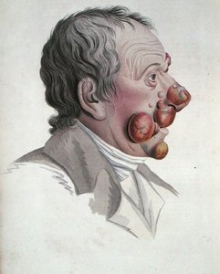 Mycosis Fongoide, uit een boek door Baron Jean Louis Alibert 1838 (gekleurde gravure) door French School
