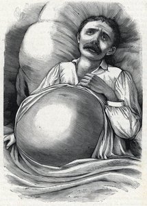 Patiënt met gevorderde levercirrose (gravure) 1888