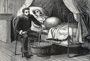 Patiënt met gevorderde levercirrose, dokter voert een punctie uit (gravure) 1888 door French School
