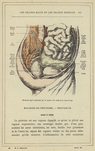 Acute peritonitis veroorzaakt door een gescheurd abces in de iliacale fossa