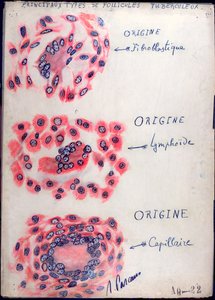 Principiële tuberculose follikels