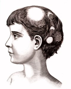 Ringworm bij kind. 1887 (gravure) door French School