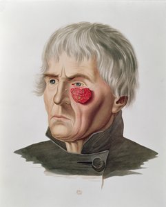 Huidaandoening voor een operatie, uit Selecta Praxis Medico-Chirurgica door Alexander Auvert, Parijs, 1856 door French School
