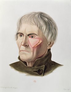 Huidtransplantatie operatie, uit Selecta Praxis Medico-Chirurgica door Alexander Auvert, Parijs, 1856 door French School