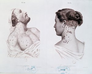 Symptomen van syfilis bij mannen en vrouwen, uit een medisch boek, c.1850-60 door French School