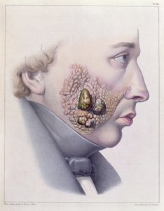 De gezichtsverschijnselen van geslachtsziekten, uit Traite Complet des Maladies Veneriennes door Philippe Ricord (1800-89) 1851 door French School