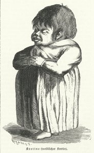 Kretin, vrouw die lijdt aan aangeboren jodiumtekortsyndroom (gravure)